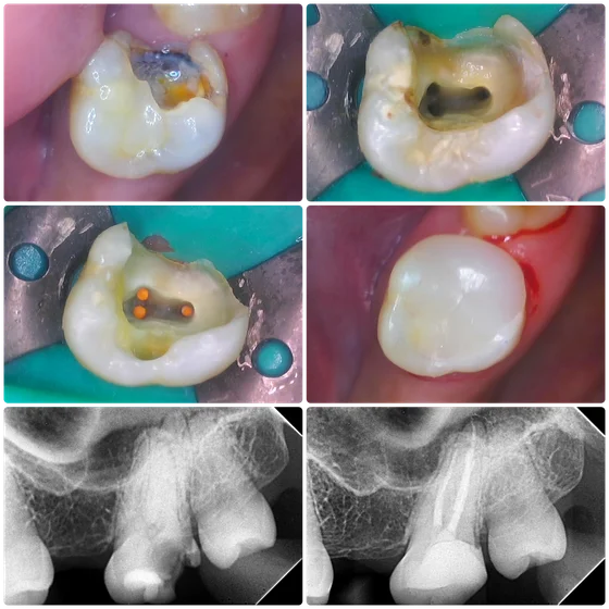 Clinic photographs of a molar with decay and subsequent treatment stages, with two X-rays