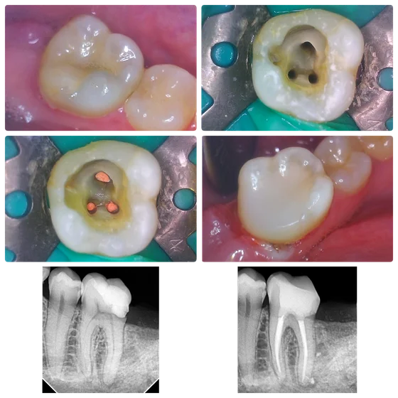 Six-panel clinic collage of a molar before, during and after treatment, with two dental X-rays