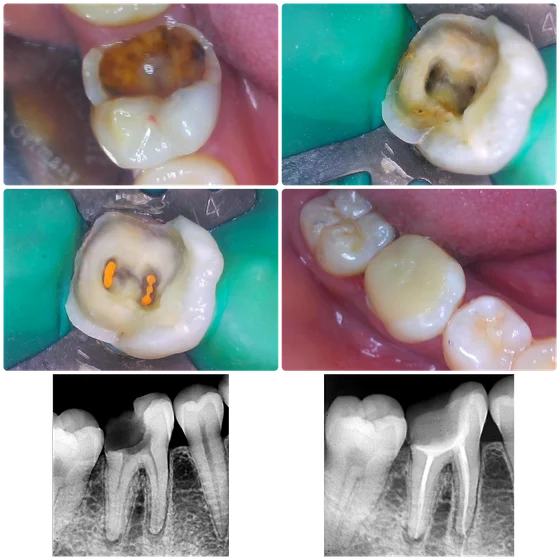 Clinic sequence of a decayed molar, root canal treatment, restoration and dental X-rays