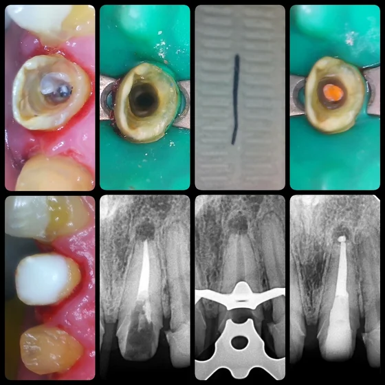 Clinic retreatment sequence with close-up tooth photographs, an instrument and dental X-rays