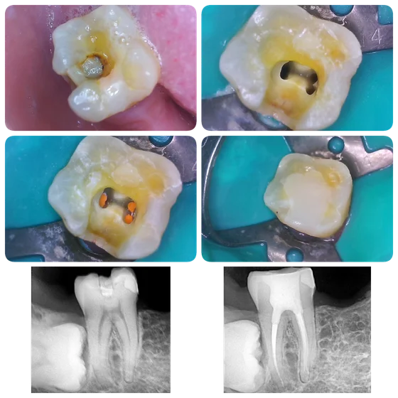 Clinic photographs of a molar at treatment stages above two dental X-rays