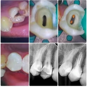 Clinic case sequence showing a premolar, treatment stages and dental X-rays