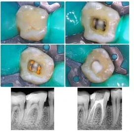 Clinic case sequence showing dental treatment photographs and two X-rays of a molar