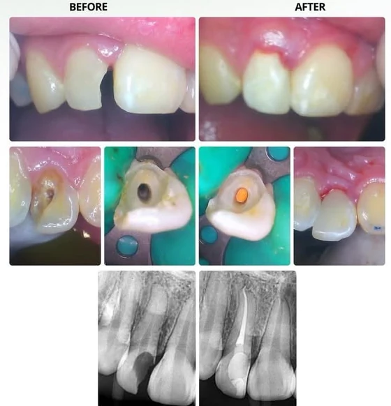 Clinic-provided dental photographs and X-rays documenting treatment and restoration stages for a front tooth